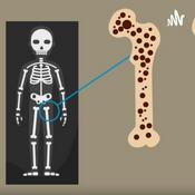Podcast Osteoporosis